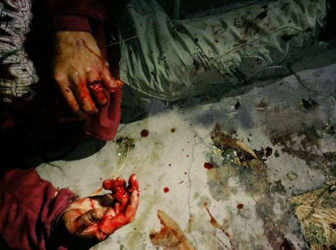 A machetazos le arrancan el dedo y dejan gravemente herido a un presunto ladrón de autos (foto muy fuerte) 2