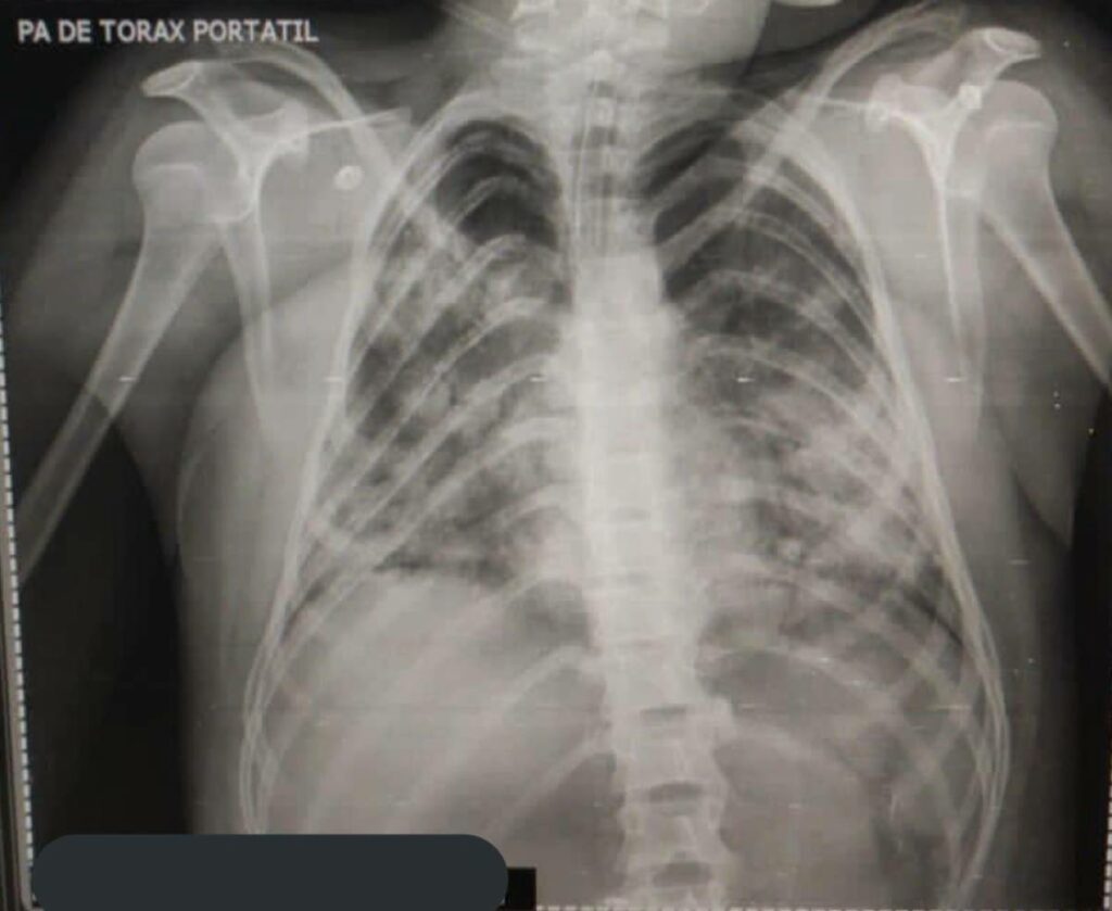 El médico cirujano e investigador Héctor Rossete subió una radiografía de los pulmones de un adolescente de 13 años afectado con covid y el cual murió a los pocos días de tener “síntomas aparentemente leves” que empezaron como un resfriado.